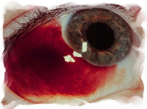 出血 白目 左右の白目が真っ赤になる結膜下出血、何度も起こり心配：朝日新聞デジタル
